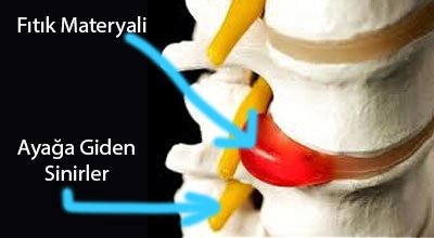 Bel Fıtığı Nedir
