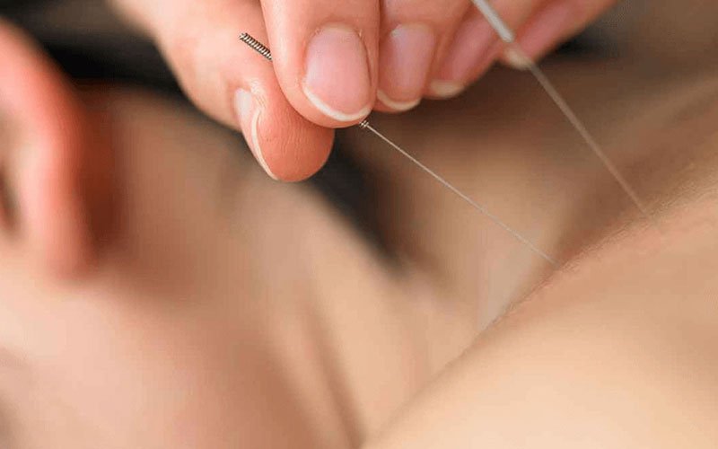 Kuru İğne, İntramüsküler Stimülasyon (IMS)
